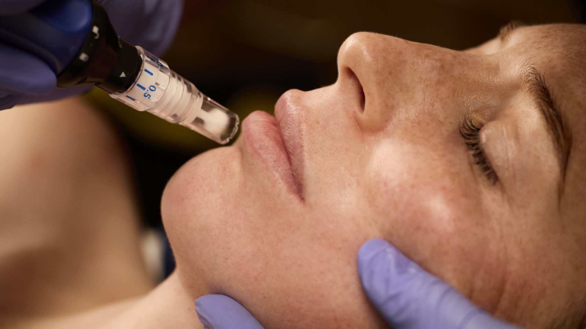 Improve the appearance of facial <em>acne scars</em>