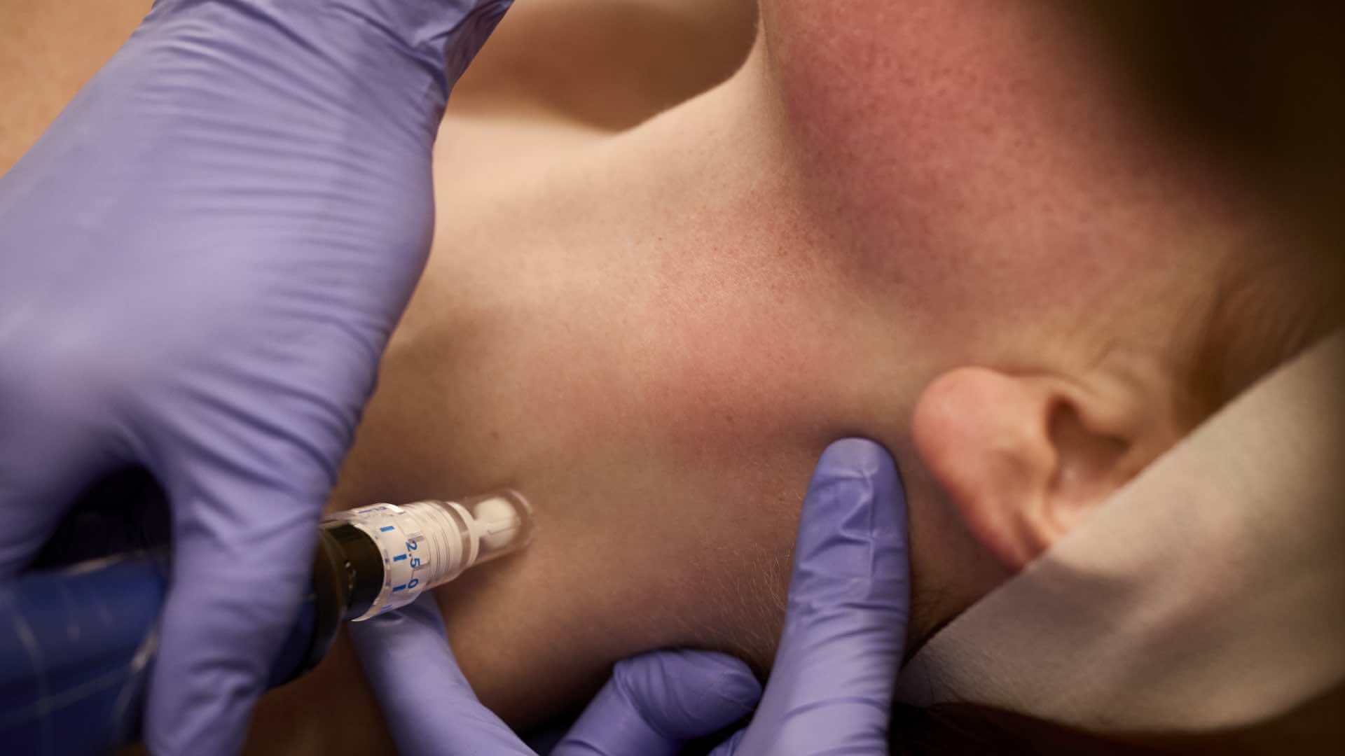 What can I expect during a SkinPen <em>treatment</em>?